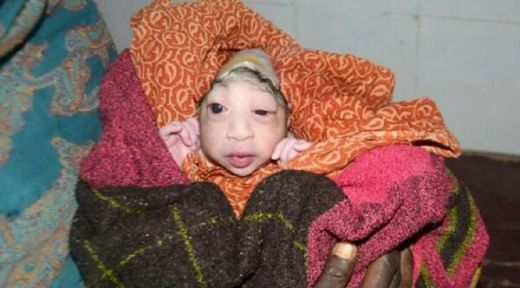 Bayi Mirip Alien Lahir di India, Ibunya Menolak Menyusukan