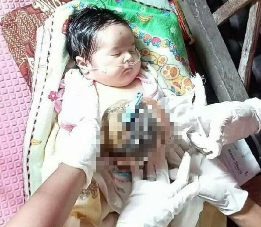 Tak Punya Biaya Lagi, Dedek Bayi Pengidap Omfalokel Terpaksa Keluar dari RSUD Arifin Achmad