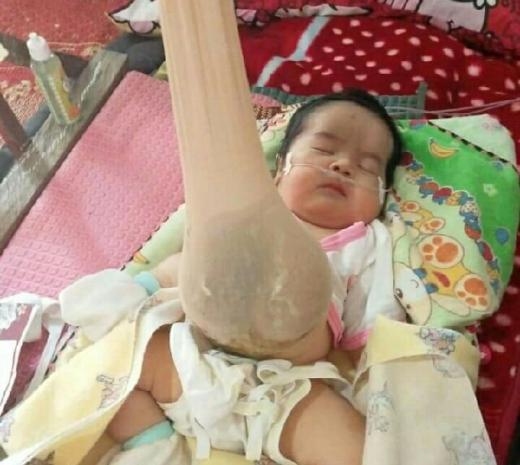 Dirut RSUD Arifin Achmad Klaim Tak Minta Biaya Dedek Bayi Pengidap Omfalokel