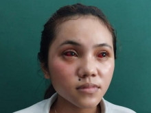 Terpapar Gas Air Mata Kedaluwarsa, Mahasiswi Malang Ini Matanya Merah dan Perih