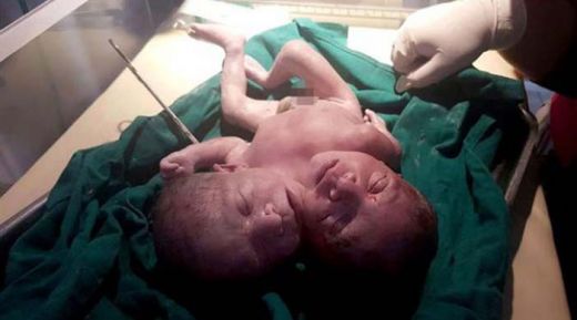 Bayi Ini Lahir dengan 2 Kepala 1 Badan, Orangtua Anggap Sebagai Hadiah dari Tuhan